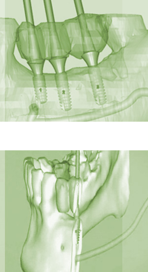 zahn-Implantate-koeln